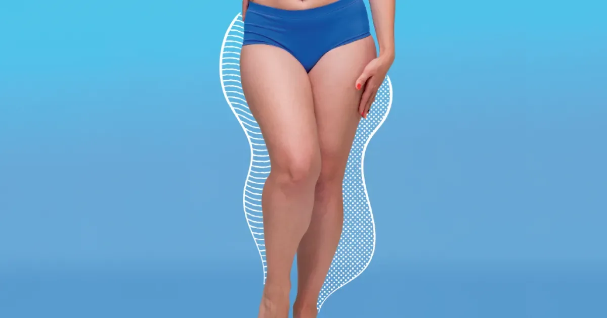 Lipedema exige avaliação médica e não deve ser confundido com celulite