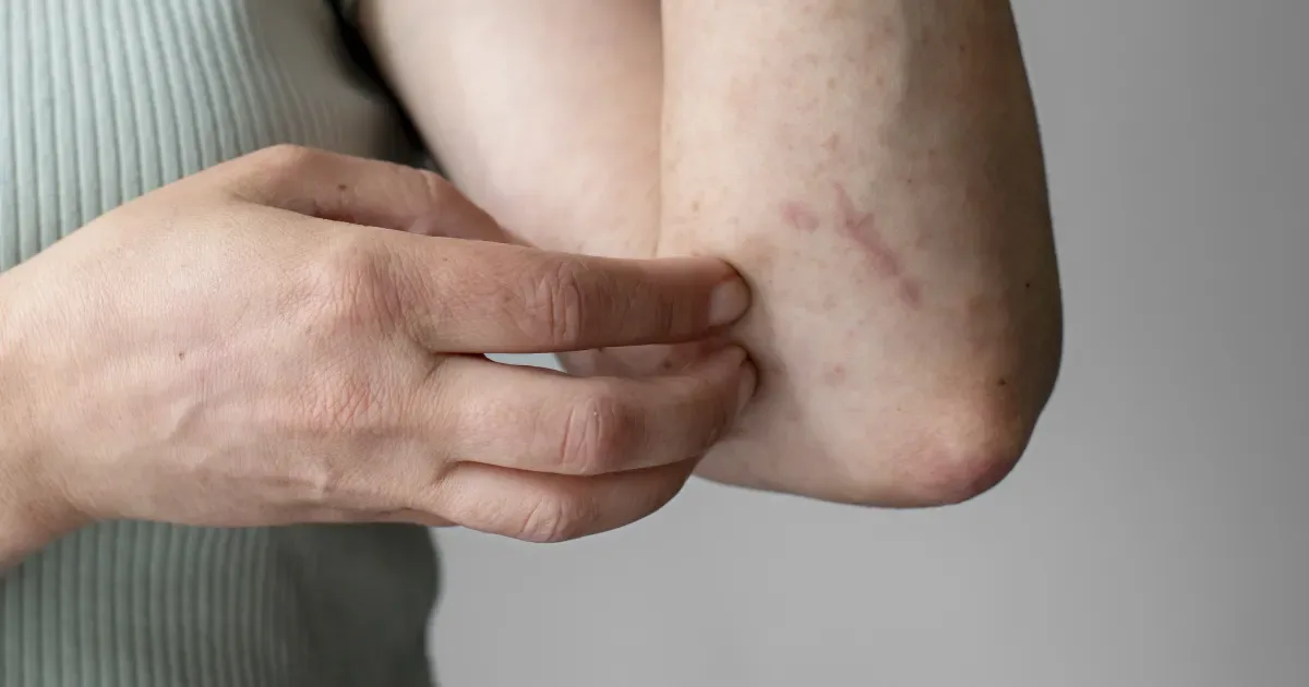 Dermatilomania provoca escoriações impulsivas e pode exigir tratamento combinado