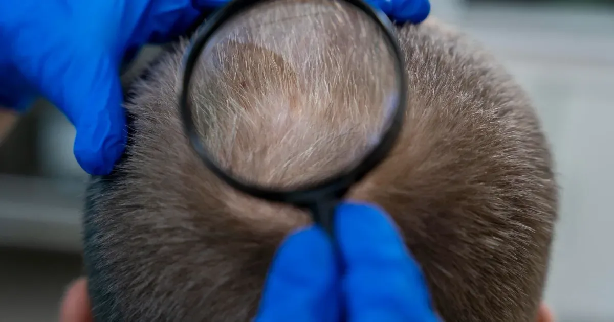 Células do folículo criam força que conduz o fio de cabelo até a pele