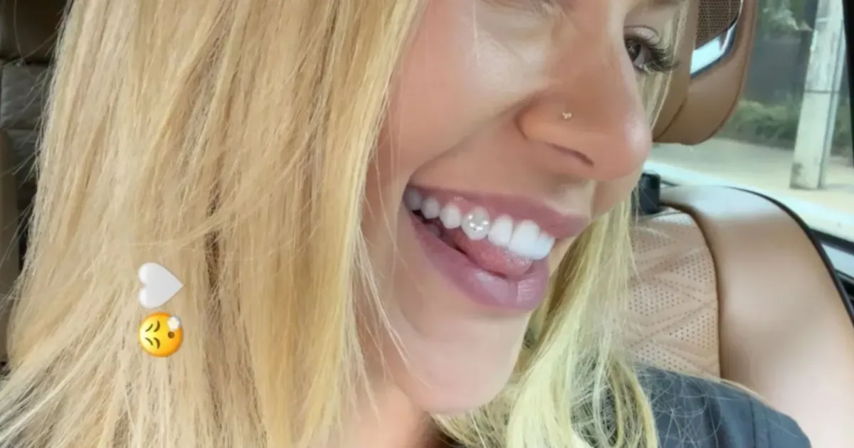 Joia dental pode afetar mordida e favorecer cárie sem cuidados, diz dentista