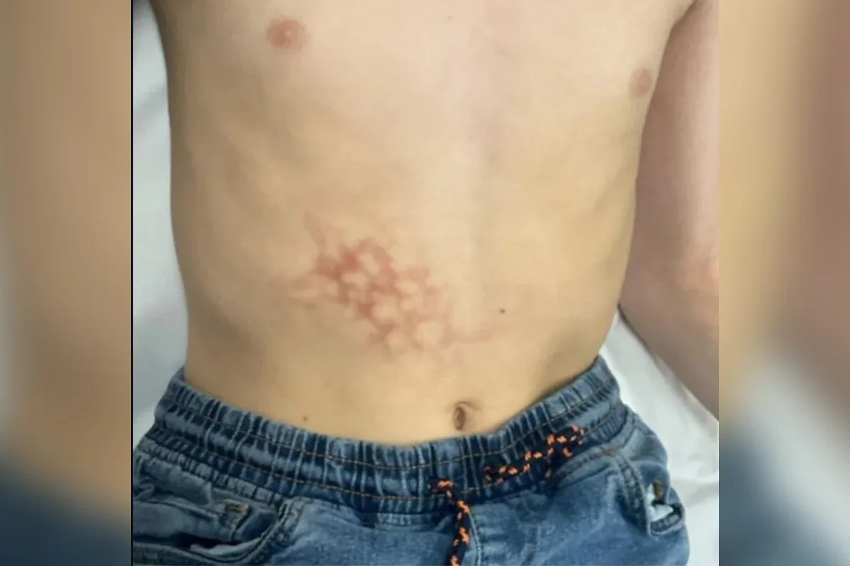 Calor de notebook provoca lesão na barriga de menino, alertam médicos britânicos